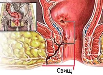 Хронический парапроктит