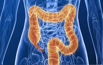 Неспецифический язвенный колит