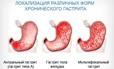 Поверхностный антральный гастрит