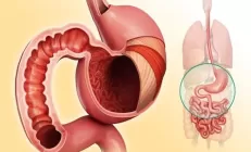 Не повреди: как боль в желудке и изжога связаны с проницаемостью слизистой ЖКТ