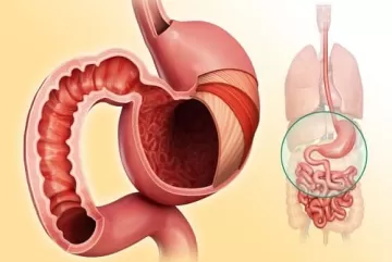 Не повреди: как боль в желудке и изжога связаны с проницаемостью слизистой ЖКТ