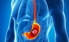 Рак желудка ближе, чем кажется