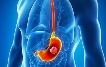 Рак желудка ближе, чем кажется