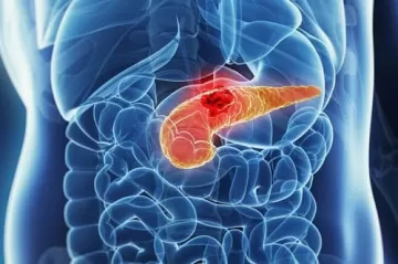 Учёным удалось победить рак поджелудочной