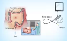 Можно ли обойтись без колоноскопии?