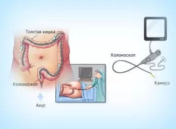 Можно ли обойтись без колоноскопии?