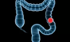 Добавки железа могут спровоцировать развитие рака толстой кишки