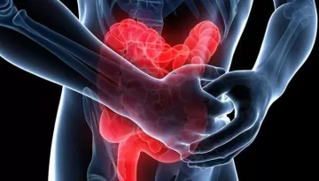 Недостаток витамина D повышает риск рецидива у больных с язвенным колитом