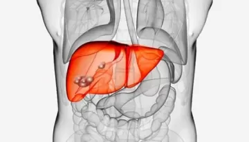 Могут ли таурин и чайные полифенолы справиться с жировой болезнью печени?