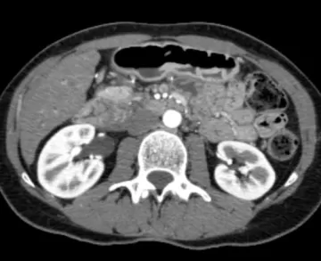 Длинная культя пузырного протока
