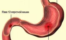Язва луковицы 12-перстной кишки, лечение, диета