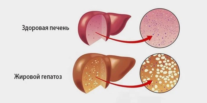 Жировой гепатоз печени фото