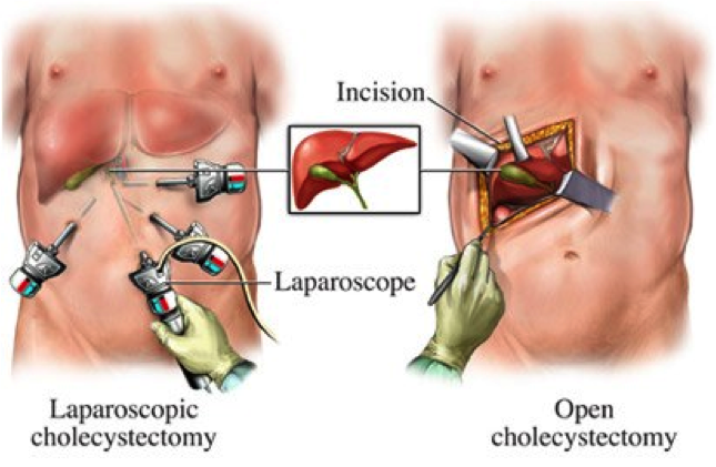 Подготовка к операции по удалению желчного пузыря лапароскопия: исследования перед холецистэктомией